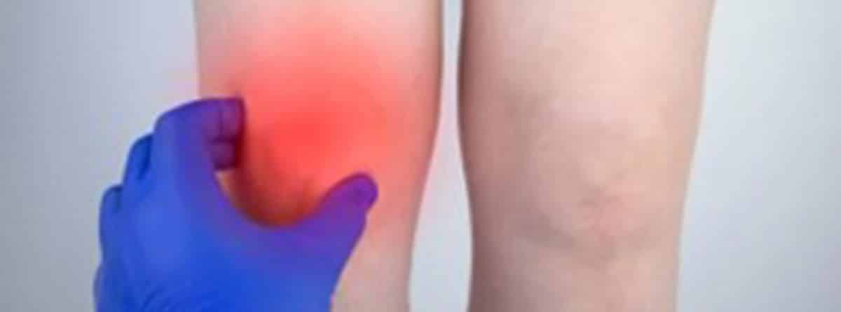 ¿Cuál es el tiempo de baja por edema óseo?